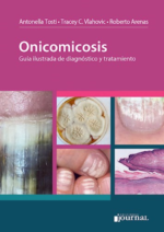 Tosti Onicomicosis